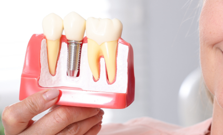 Dental Implants in Southam — Your Options Explained